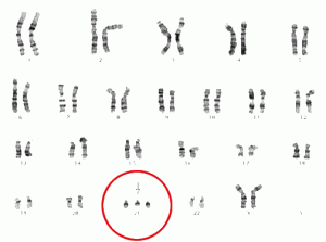 A karyotype shows the presence of three copies of the 21st chromosome, indicating Down syndrome.